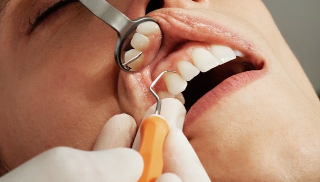 Invisalign: Jak działa i dla kogo jest przeznaczony?